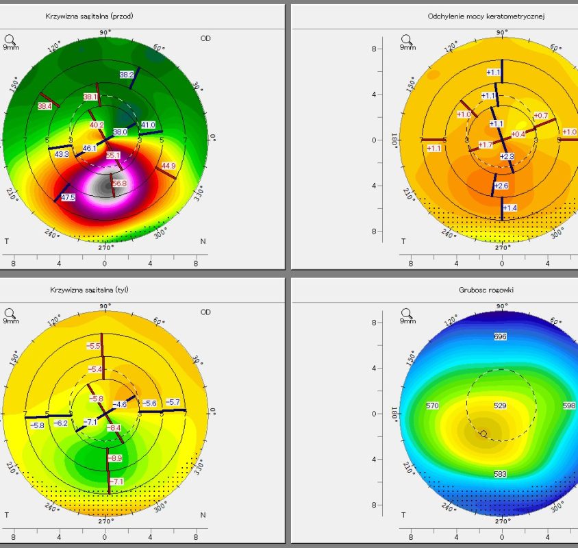 Jeśli mimo tego, że dbasz o wzrok, wciąż nie widzisz dobrze – uważaj na stożek rogówki!