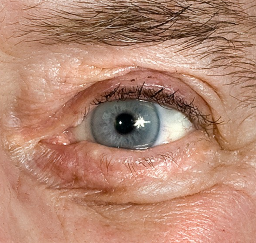 Zakażenie nużeńcem – przyczyny, objawy i leczenie