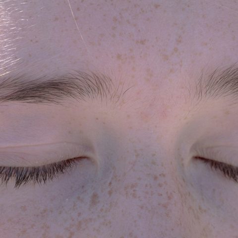 Na czym polega zespół kociego oka?