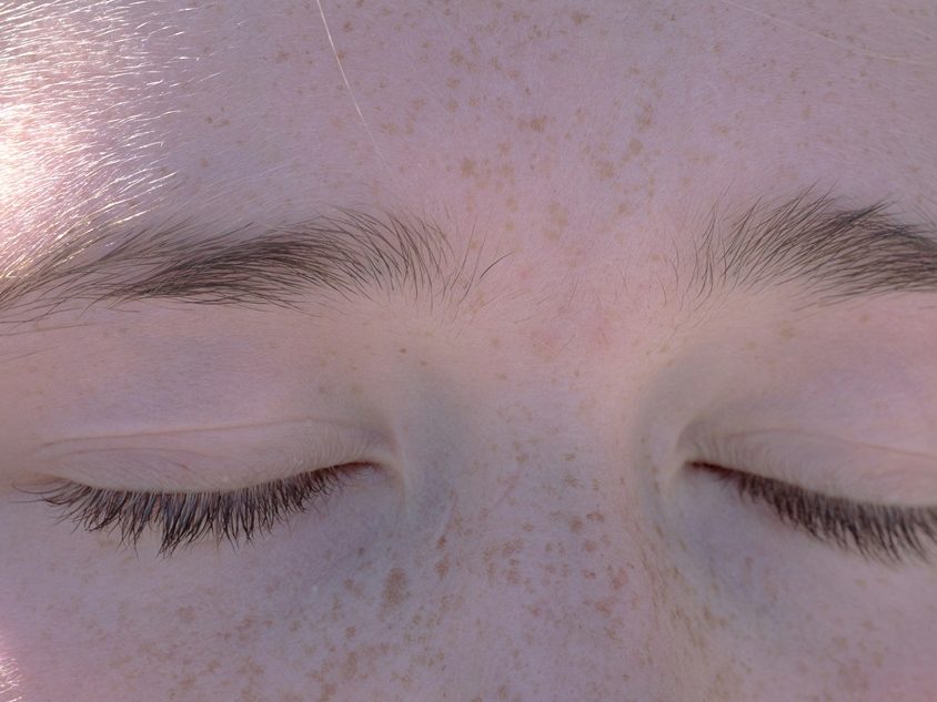 Na czym polega zespół kociego oka?